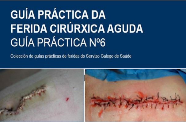 Guía práctica da ferida cirúrxica aguda. Guía nº6