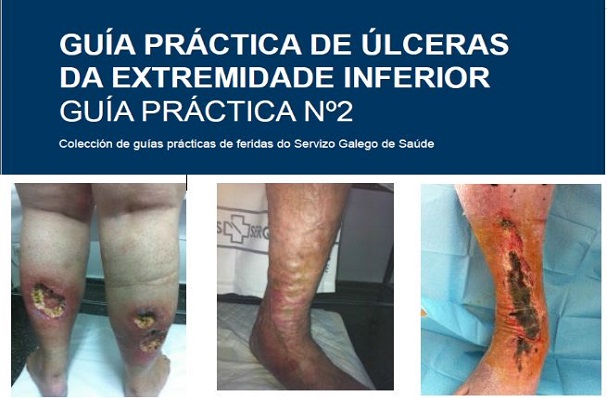 Guía práctica de úlceras da extremidade inferior. Guía nº2